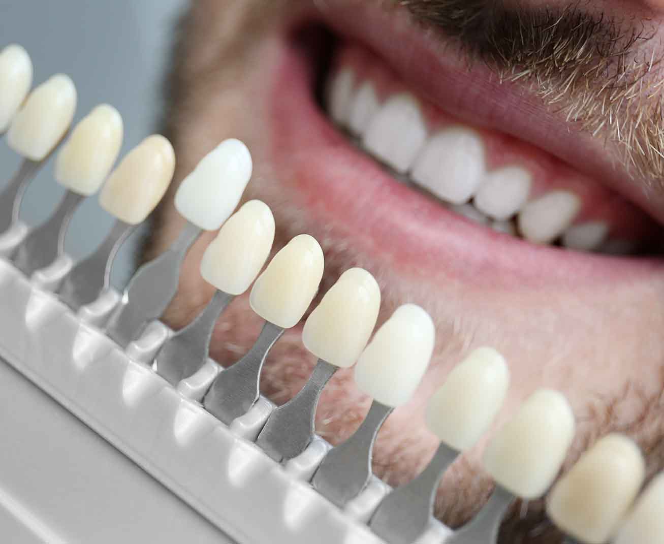 zahnarztpraxis-hlavacek-bleaching Zahnfarben werden anhand eines Musters mit den Zähnen eines Mannes abgeglichen.